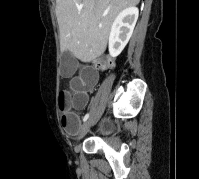 File:Closed loop small bowel obstruction (Radiopaedia 71211-81508 C 27).jpg