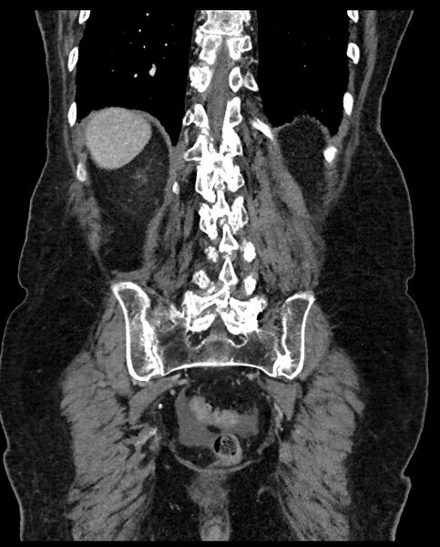 File:Closed loop small bowel obstruction - adhesions (Radiopaedia 59269-66611 B 99).jpg