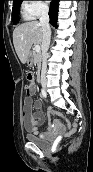 File:Closed loop small bowel obstruction - adhesive band with a C-shaped loop (Radiopaedia 83832-99018 C 69).jpg