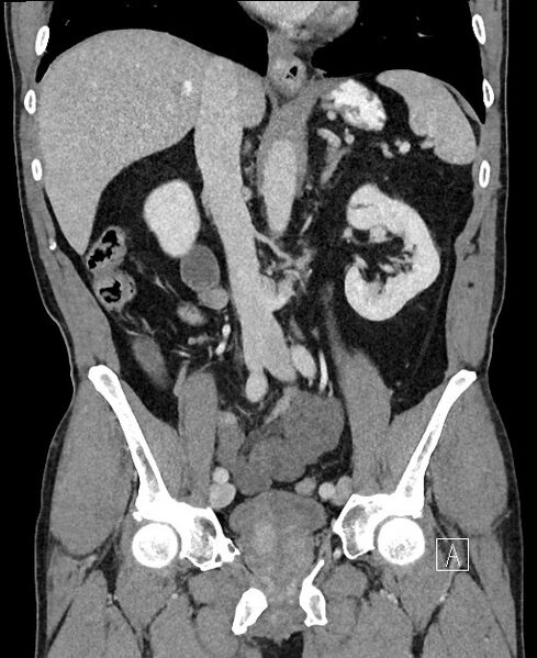 File:Closed loop small bowel obstruction - internal hernia (Radiopaedia 57806-64778 A 60).jpg