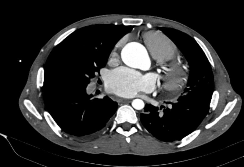 File:Coarctation of aorta with aortic valve stenosis (Radiopaedia 70463-80574 A 106).jpg