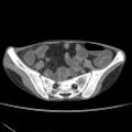 Colocolic fistula - Crohn disease (Radiopaedia 57063-63955 A 66).jpg