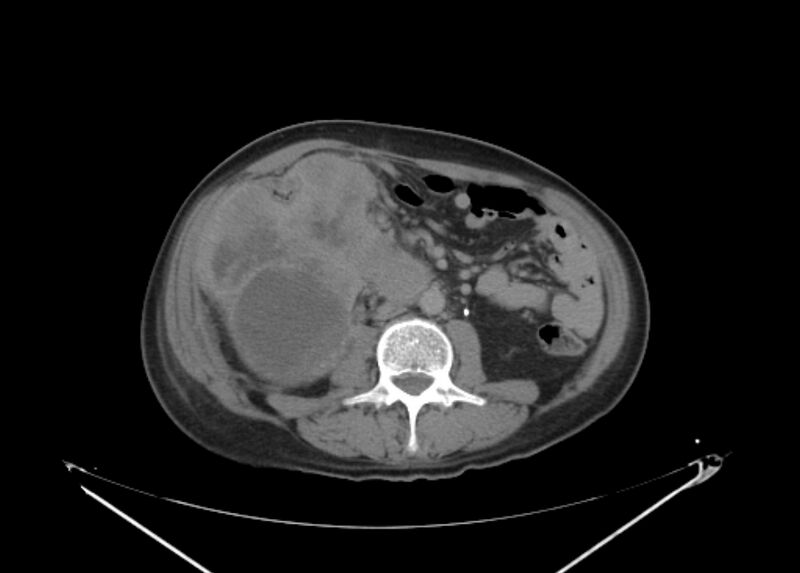 File:Colon cancer mimicking renal cell carcinoma (Radiopaedia 28986-29335 Axial C+ delayed 40).jpg
