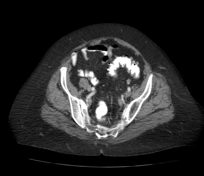 File:Colonic diverticulosis (Radiopaedia 22934-22957 A 58).jpg