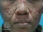Facial nodules with talaromycosis (DermNet NZ penicilliosis-v3).jpg