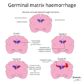Germinal matrix hemorrhage grading (Radiopaedia 79252).png