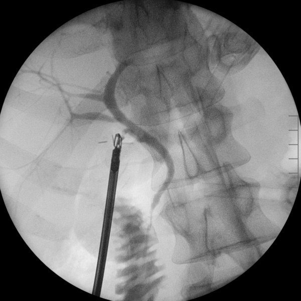 File:Intraoperative cholangiogram post cholecystectomy - normal (Radiopaedia 78163).PNG