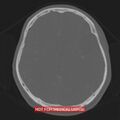 Nasopharyngeal carcinoma recurrence - skull base destruction (Radiopaedia 29107-29490 Axial bone window 51).jpg