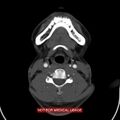 Nasopharyngeal carcinoma recurrence - skull base destruction (Radiopaedia 29107-29491 A 23).jpg