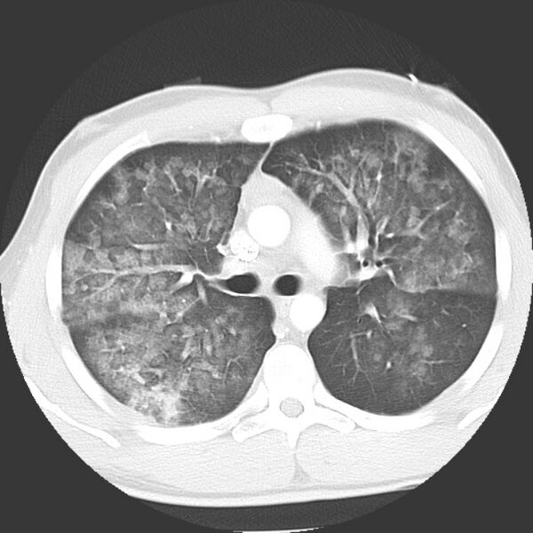 File:Near drowning pulmonary edema (Radiopaedia 16868-16591 Axial lung window 17).jpg