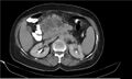 Necrotizing pancreatitis (Radiopaedia 20595-20495 Axial C+ delayed 16).jpg