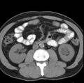 Necrotizing pancreatitis with acute necrotic collection (Radiopaedia 14470-14417 Axial non-contrast 25).jpg