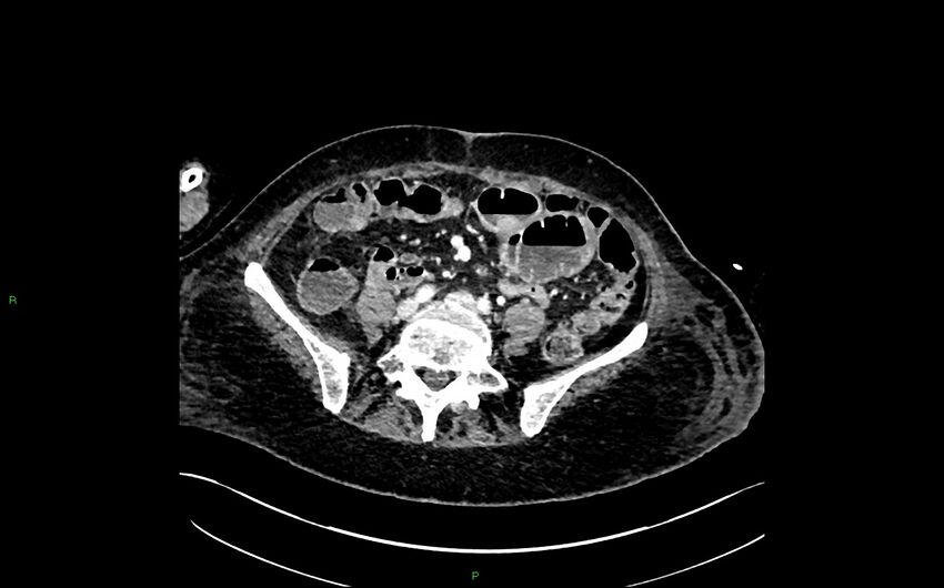 Neo-terminal ileal stricture (Crohn disease) (Radiopaedia 33790-34948 A 302).jpg