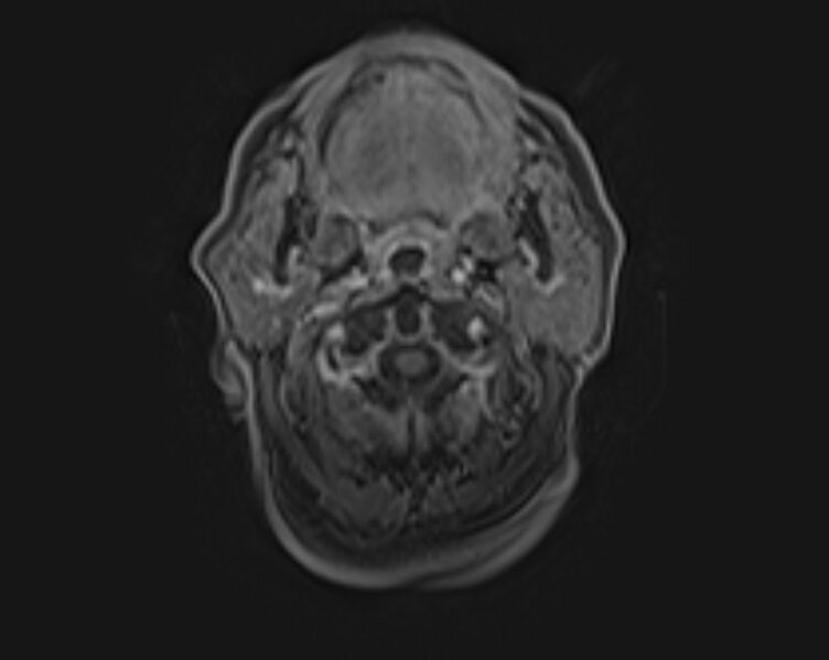 File:Non-Hodgkin lymphoma - parotid gland (Radiopaedia 71531-81890 E 39).jpg