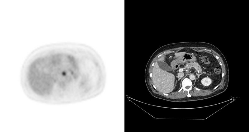 File:Non-Hodgkin lymphoma involving seminal vesicles with development of interstitial pneumonitis during Rituximab therapy (Radiopaedia 32703-33675 axial PET CT 34).jpg