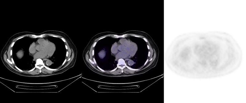 File:Non-Hodgkin lymphoma involving seminal vesicles with development of interstitial pneumonitis during Rituximab therapy (Radiopaedia 32703-33752 ax CT Fus PET 25).jpg