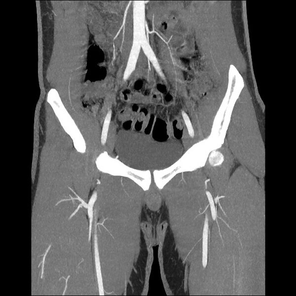 File:Normal CT angiogram of pelvis (Radiopaedia 45390-49430 B 19).jpg