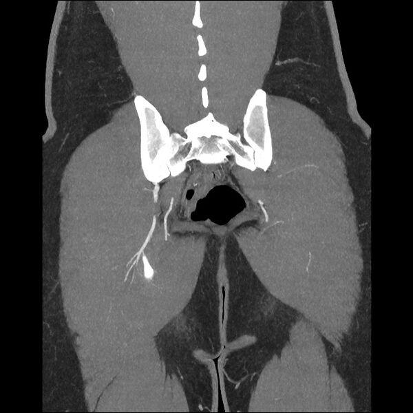 File:Normal CT angiogram of pelvis (Radiopaedia 45390-49430 B 38).jpg