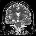 Normal coronal brain (Radiopaedia 6676-7910 Coronal T2 21).jpg