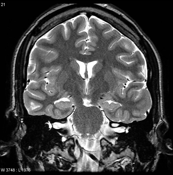 File:Normal coronal brain (Radiopaedia 6676-7910 Coronal T2 21).jpg