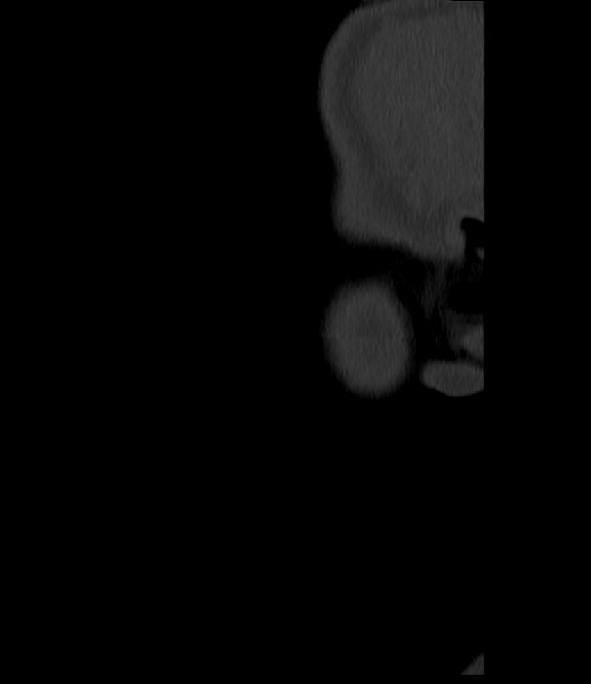Normal facial bone CT (Radiopaedia 88742-105476 Sagittal bone window 9).jpg
