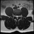 Normal lumbar spine MRI (Radiopaedia 35543-37039 Axial T2 20).png