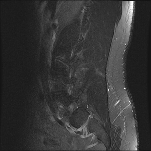 File:Normal lumbar spine MRI (Radiopaedia 43051-46311 Sagittal STIR 17).jpg