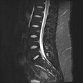 Normal lumbar spine MRI (Radiopaedia 47857-52609 Sagittal STIR 11).jpg