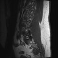 Normal lumbar spine MRI (Radiopaedia 47857-52609 Sagittal T1 3).jpg