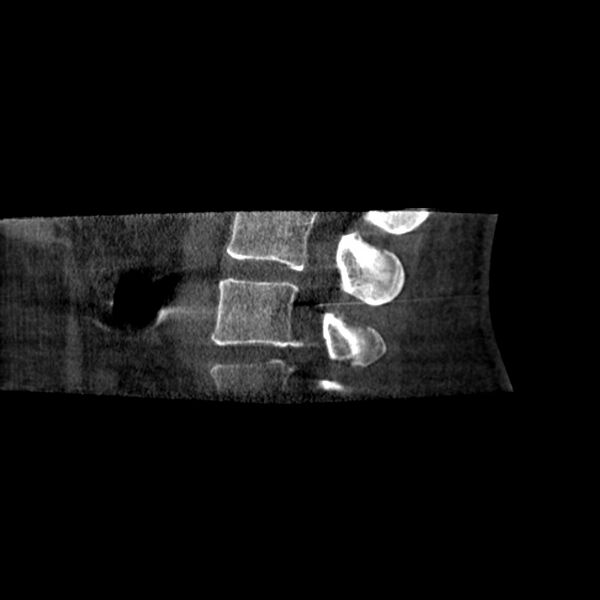 File:Oblique sublaminar lumbar puncture (Radiopaedia 90103-107350 B 9).jpeg