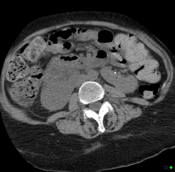 File:Obstructed infected horseshoe kidney (Radiopaedia 18116-17898 non-contrast 14).jpg