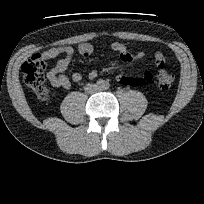 Obstructing ureteric calculus and ureteric anatomy (Radiopaedia 62730-71042 Axial non-contrast 79).jpg