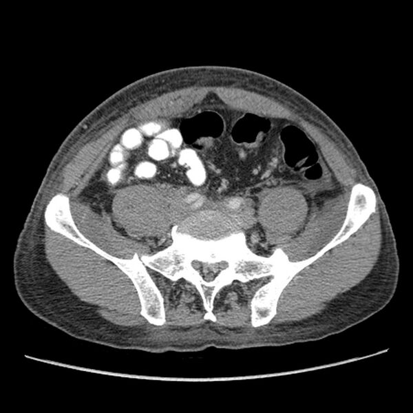 File:Obstructive bladder transitional cell carcinoma (Radiopaedia 9825-10410 A 21).jpg