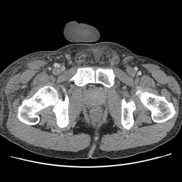File:Obstructive bladder transitional cell carcinoma (Radiopaedia 9825-10410 A 37).jpg