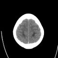 Obstructive hydrocephalus (Radiopaedia 30453-31119 Axial non-contrast 24).jpg