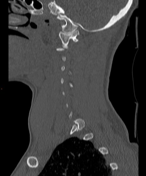 File:Occipital condyle fracture (Radiopaedia 61165-69056 Sagittal bone window 7).jpg