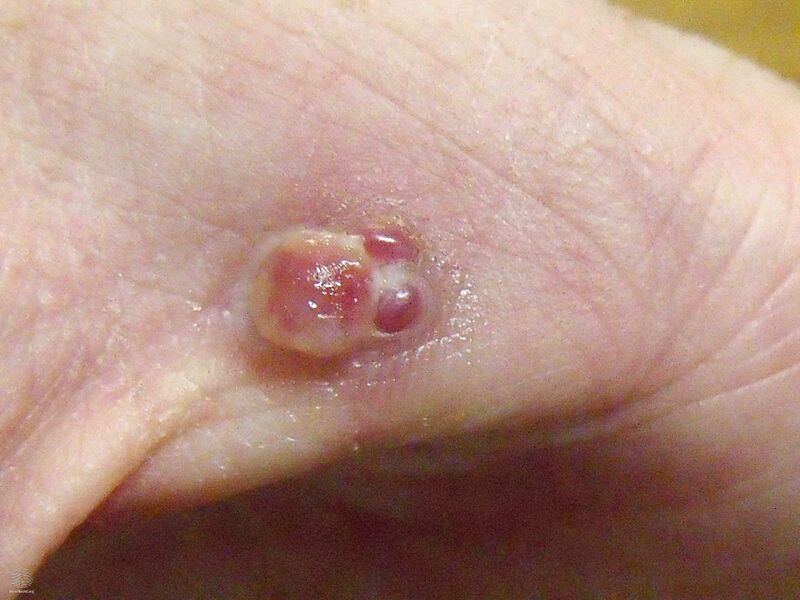 File:Pyogenic granuloma of the hand (DermNet NZ pyogenic-granuloma-hand-v2).jpg