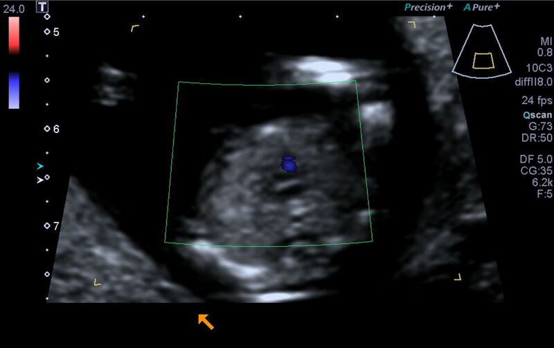File:1st trimester nuchal-morphology ultrasound (Radiopaedia 44706-48477 Heart views cine with colour 130).jpg