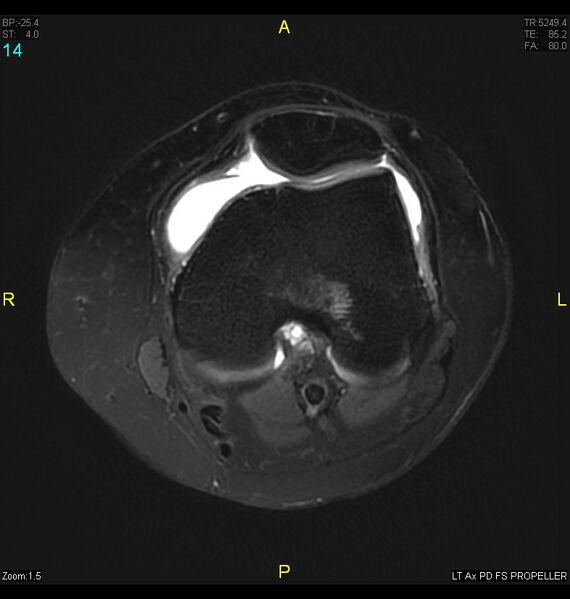 File:ACL mucoid degeration with cystic changes (Radiopaedia 48428-53341 Axial PD fat sat 11).jpg
