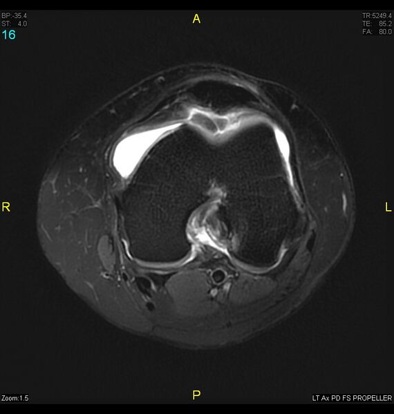 File:ACL mucoid degeration with cystic changes (Radiopaedia 48428-53341 Axial PD fat sat 13).jpg