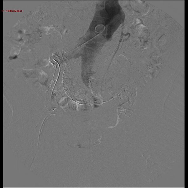 File:Abdominal aortic aneurysm (Radiopaedia 16155-15833 Frontal Aorta 2).jpg