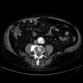 Abdominal aortic aneurysm (Radiopaedia 25855-26001 Axial C+ arterial phase 82).jpg