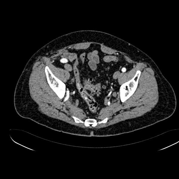 File:Abdominal aortic aneurysm (Radiopaedia 75131-86203 Axial C+ arterial phase 40).jpg