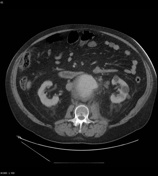 File:Abdominal aortic aneurysm with intramural hematoma then rupture (Radiopaedia 50278-55631 Axial C+ arterial phase 74).jpg