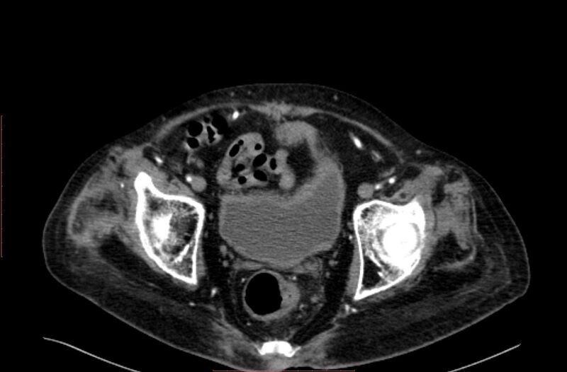 File:Abdominal aortic interposition tube graft and aneurysm thrombosis (Radiopaedia 71438-81857 Axial C+ arterial phase 214).jpg