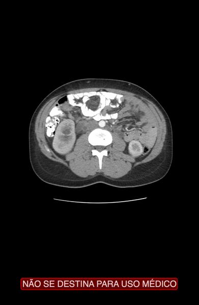 File:Abdominal desmoid tumor (Radiopaedia 44024-47540 Axial C+ arterial phase 13).jpg