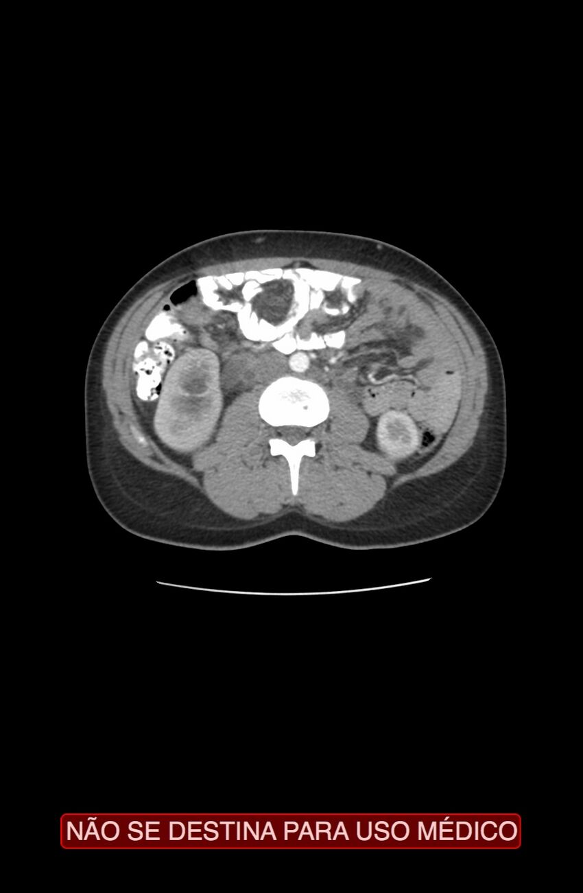 Abdominal desmoid tumor (Radiopaedia 44024-47540 Axial C+ arterial phase 13).jpg