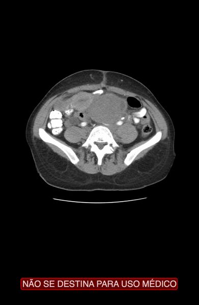 File:Abdominal desmoid tumor (Radiopaedia 44024-47540 Axial C+ arterial phase 25).jpg