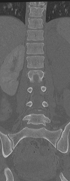 File:Abdominal multi-trauma - devascularised kidney and liver, spleen and pancreatic lacerations (Radiopaedia 34984-36486 Coronal bone window 36).png