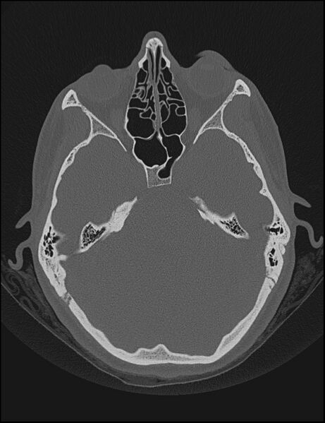 File:Aberrant right internal carotid artery (Radiopaedia 65191-74198 Axial non-contrast 58).jpg